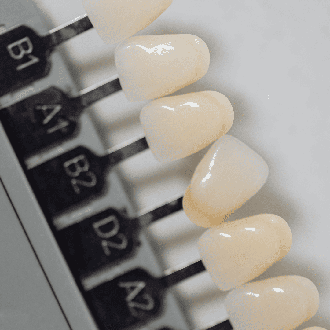 روکش دندان در کلینیک ماه سیما